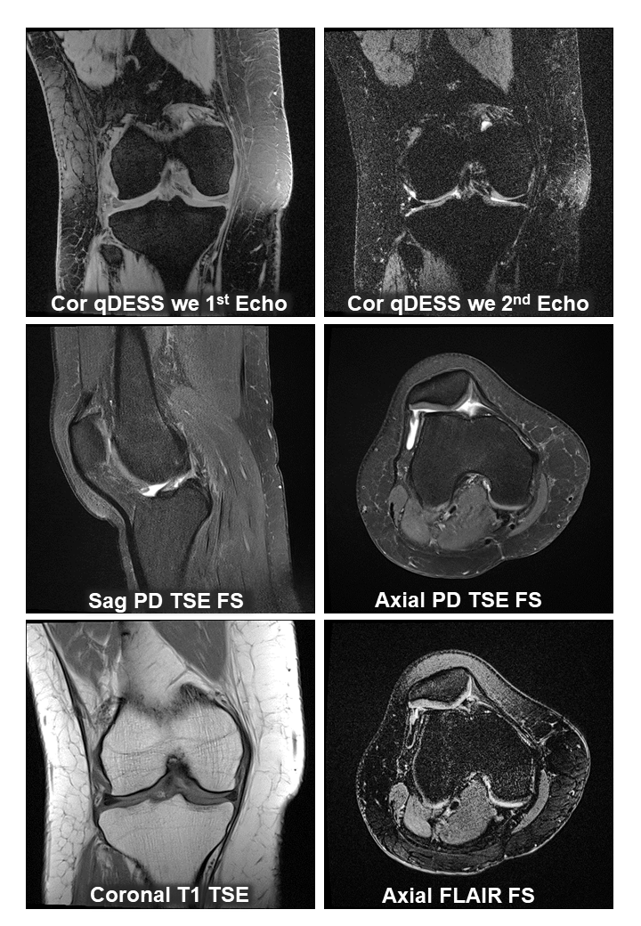 Automated Analysis of Cartilage